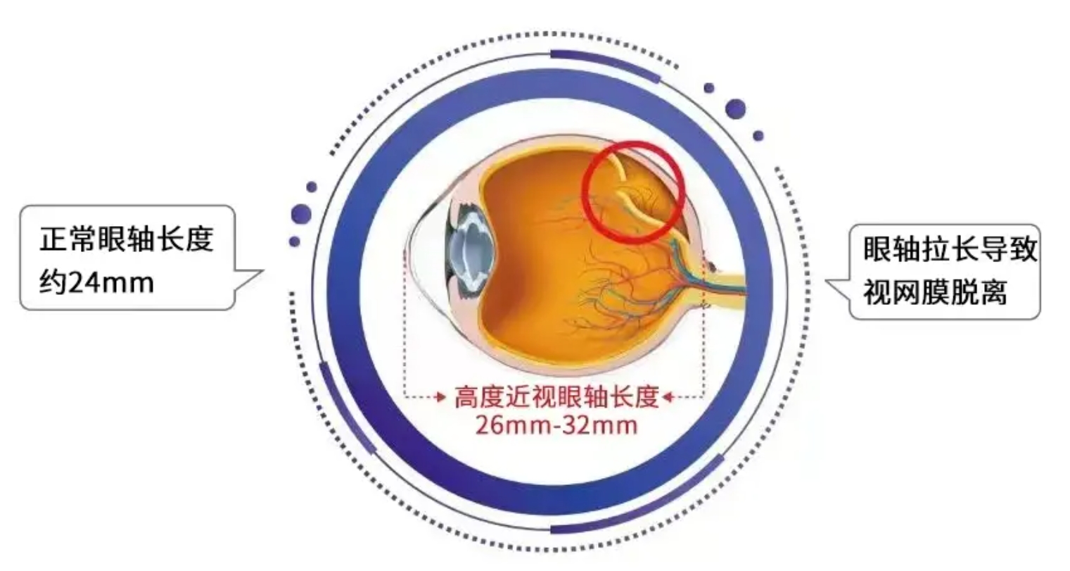 高度近视会引起眼底哪些病变？